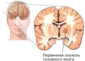 Опухоль мозга может вызывать перепад температуры тела