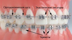 брекеты для исправления прикуса зубов