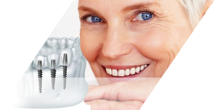 импланты для зубов