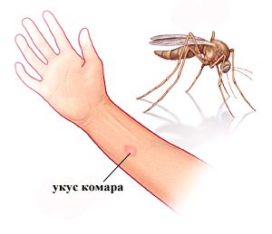 укус комара
